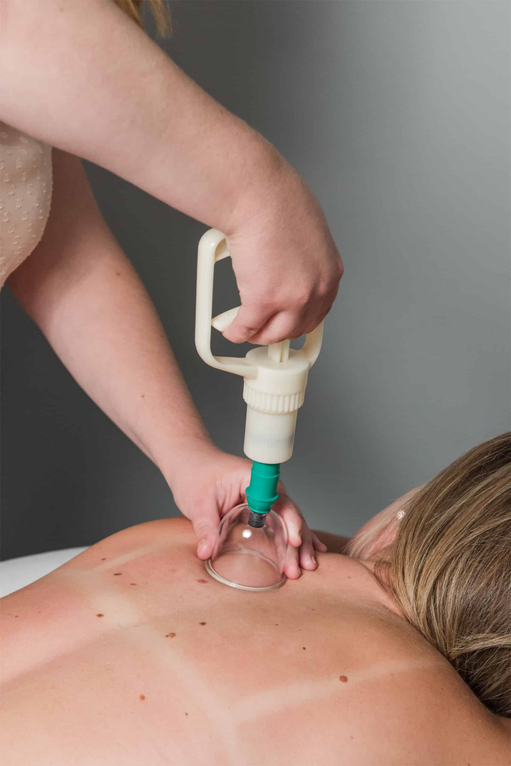 Acupuncture & Cupping - Stride Physiotherapy
